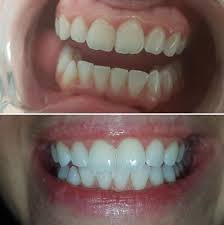 Snowhite Teeth Whitening - clareamento dos dentes - forum - Encomendar - como aplicar